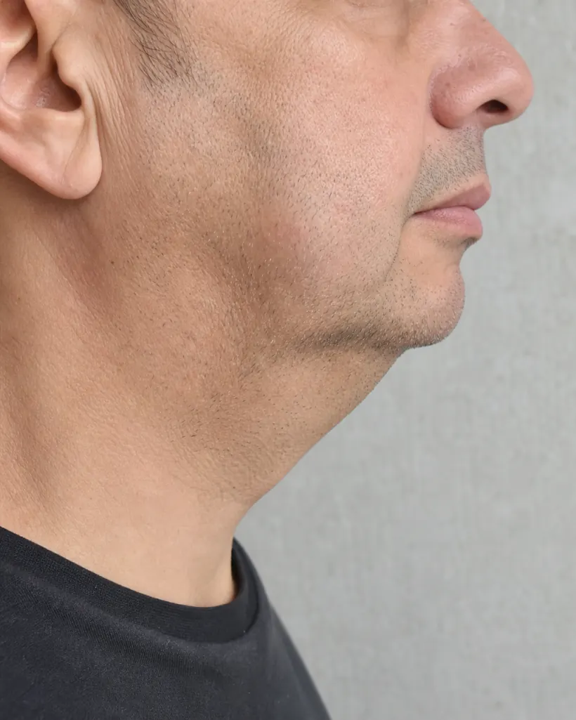 Antes: línea mandibular poco definida